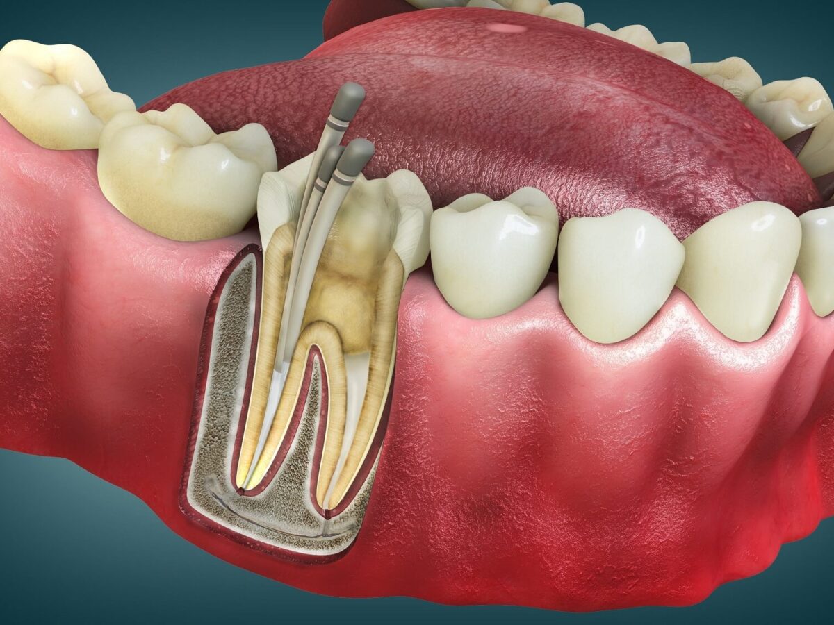Leczenie kanałowe – co to jest i kiedy jest konieczne?