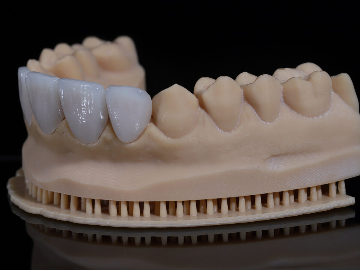 Licówki porcelanowe – co to jest i kiedy warto się na nie zdecydować?