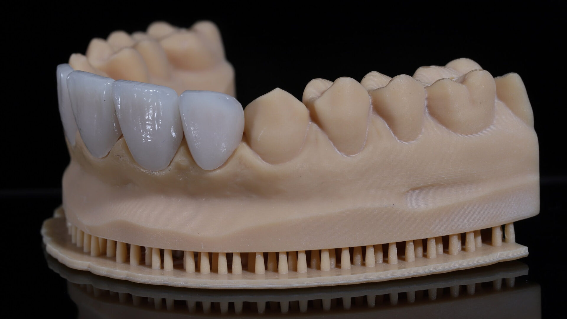 Licówki porcelanowe – co to jest i kiedy warto się na nie zdecydować?